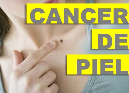 Diagnostico de Cancer de Piel, Tratamiento de Cancer de Piel, Cancer de Piel, dermatologo,