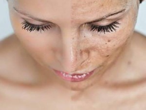 tratamiento para manchas en la cara, eliminar manchas en la cara