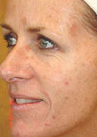 tratamiento contra acne y manchas